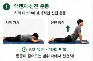 맥켄지 신전 운동 - 5초 유지 10회 반복