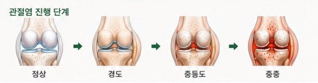 관절염 진행 단계 - 정상, 경도, 중등도, 중증